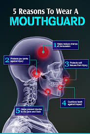 5 reasons for a mouth guard